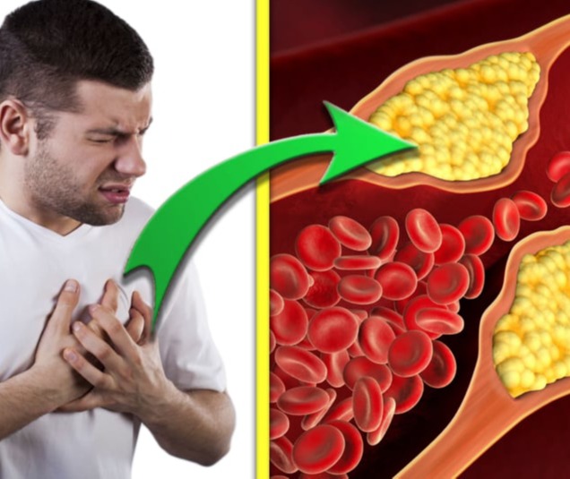 Αντιμετώπιση υψηλής χοληστερίνης